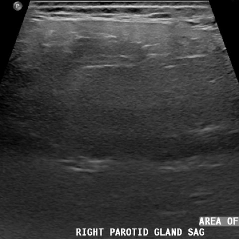 Neck ultrasound