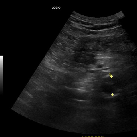 Ecocolordoppler aorta addominale