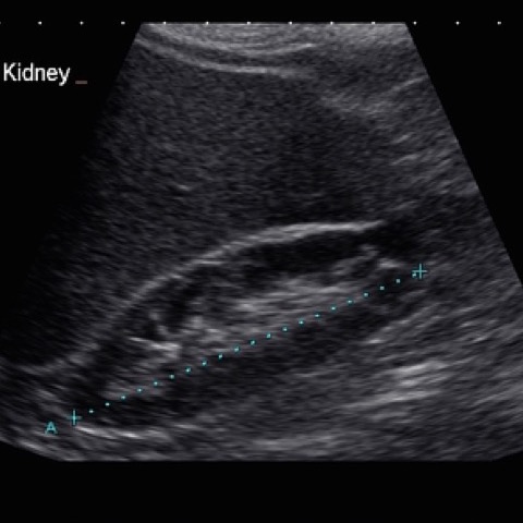 Ecocolordoppler arterie renali