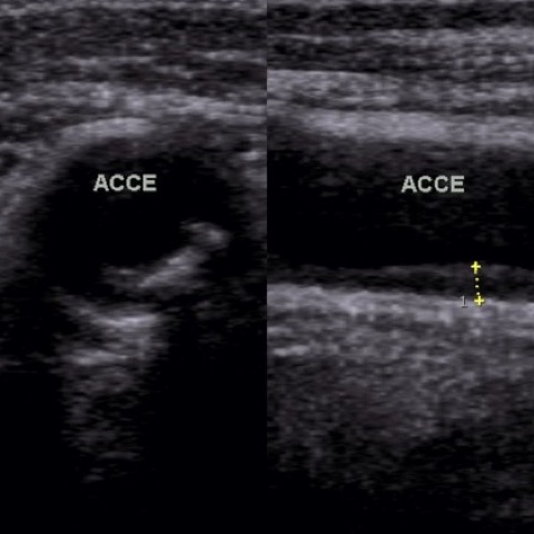Ecocolordoppler carotidi