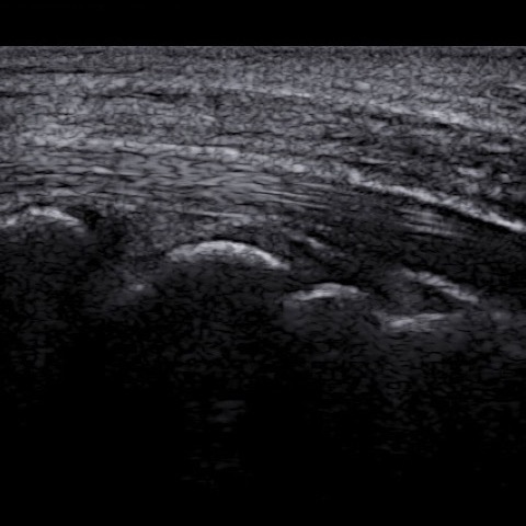 Wrist and hand ultrasound