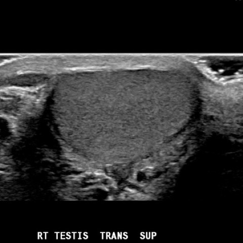 Ecografia scrotale e testicolare